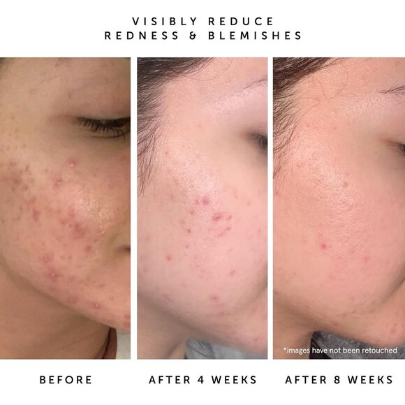 HERBIVORE Lapis Balancing Facial Oil with Blue Tansy + Squalane, Safe for Acne-P - Picture 4 of 4